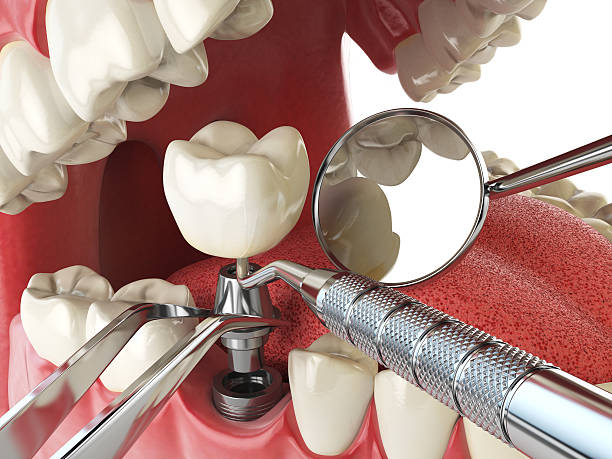 Best Emergency Treatment for Toothache in Georgetown, KY
